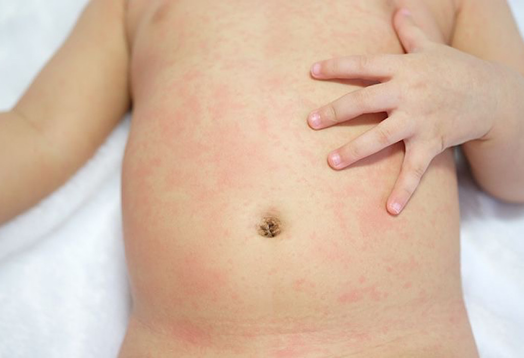 penyakit kulit pada anak eritema multiformis