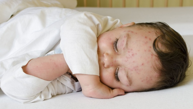cara mengobati Flu Singapura pada Bayi