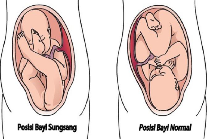 Apakah Posisi Bayi Sungsang Dapat Dicegah?