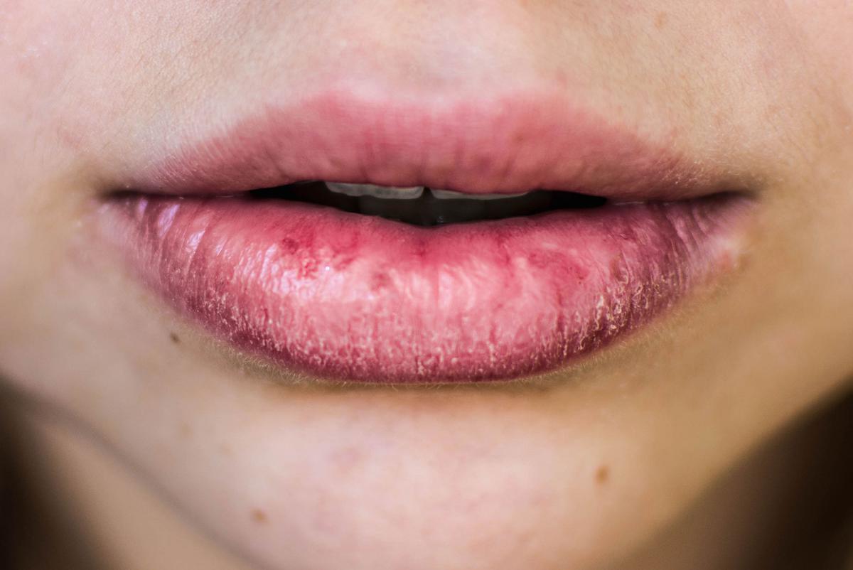 Bibir Kering Saat Hamil? Ini 4 Cara Mengatasinya