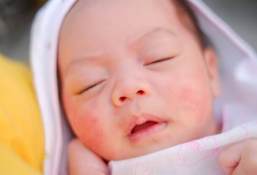 5 Penyebab Ruam Merah Pada Kulit Bayi & Cara Mengatasinya